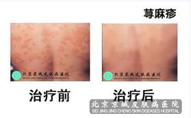 北京多家医院联合举办百名专家大会诊，专注荨麻疹与性病治疗