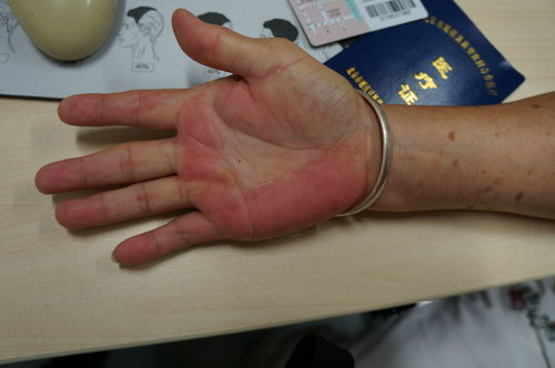 掌腱膜挛缩症与北京地区的规范诊疗